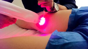 laser transdérmico varizes em teresina