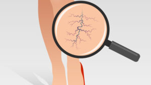 microcirurgia de varizes